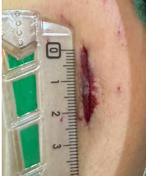 A 2 cm incision with no muscle split, keyhole cholecystectomy technique