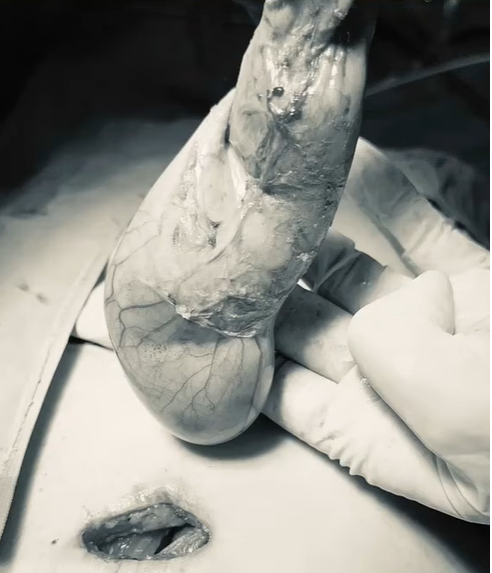 Gallbladder removal through a single small incision, performed by Dr. Abdul Qayyum Khan in Rawalpindi