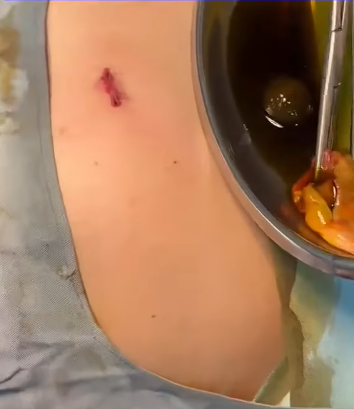 Gallbladder surgery by Dr. Abdul Qayyum Khan, general surgeon in Rawalpindi